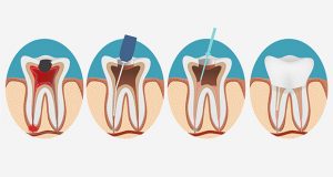 manchester family dental office root canals