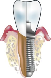dental implants in Manchester, CT