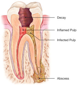 Root Canal in Manchester