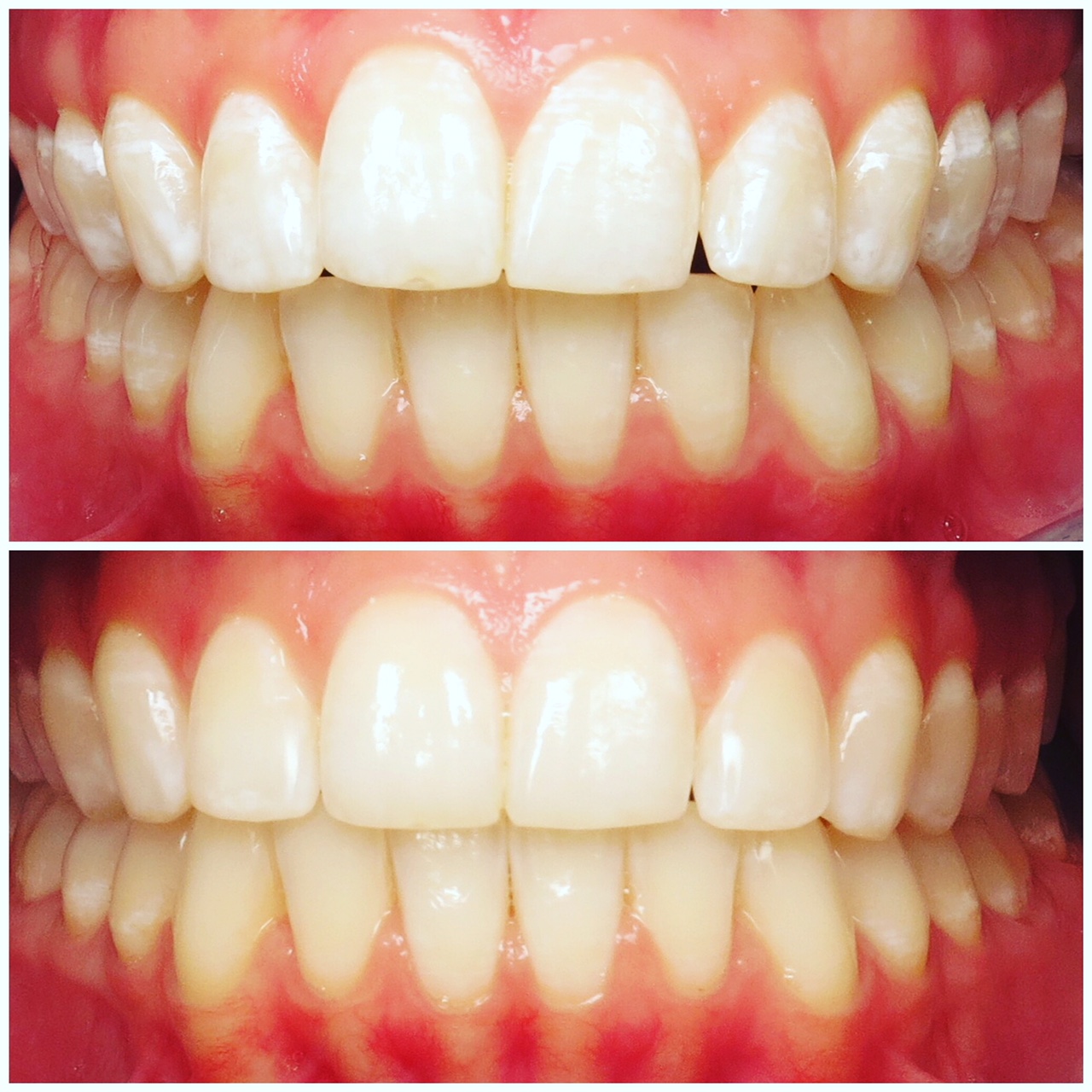 retainer for teeth before and after